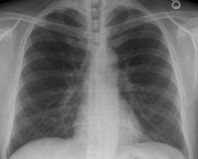 2048px-Chest_Xray_PA_3-8-2010